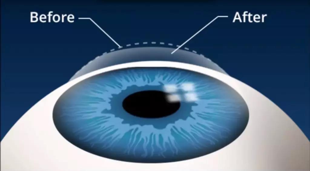​ 角膜屈光手术的基本规则---厚度规则