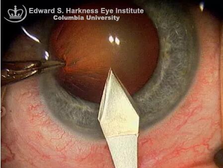 科普|白内障手术透明角膜切口的位置和构建