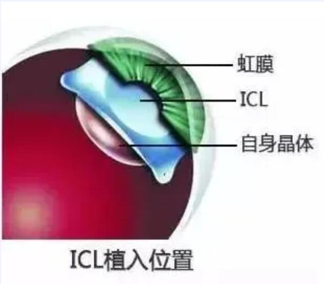 荆门近视手术中的“爱马仕”——ICL晶体植入术！